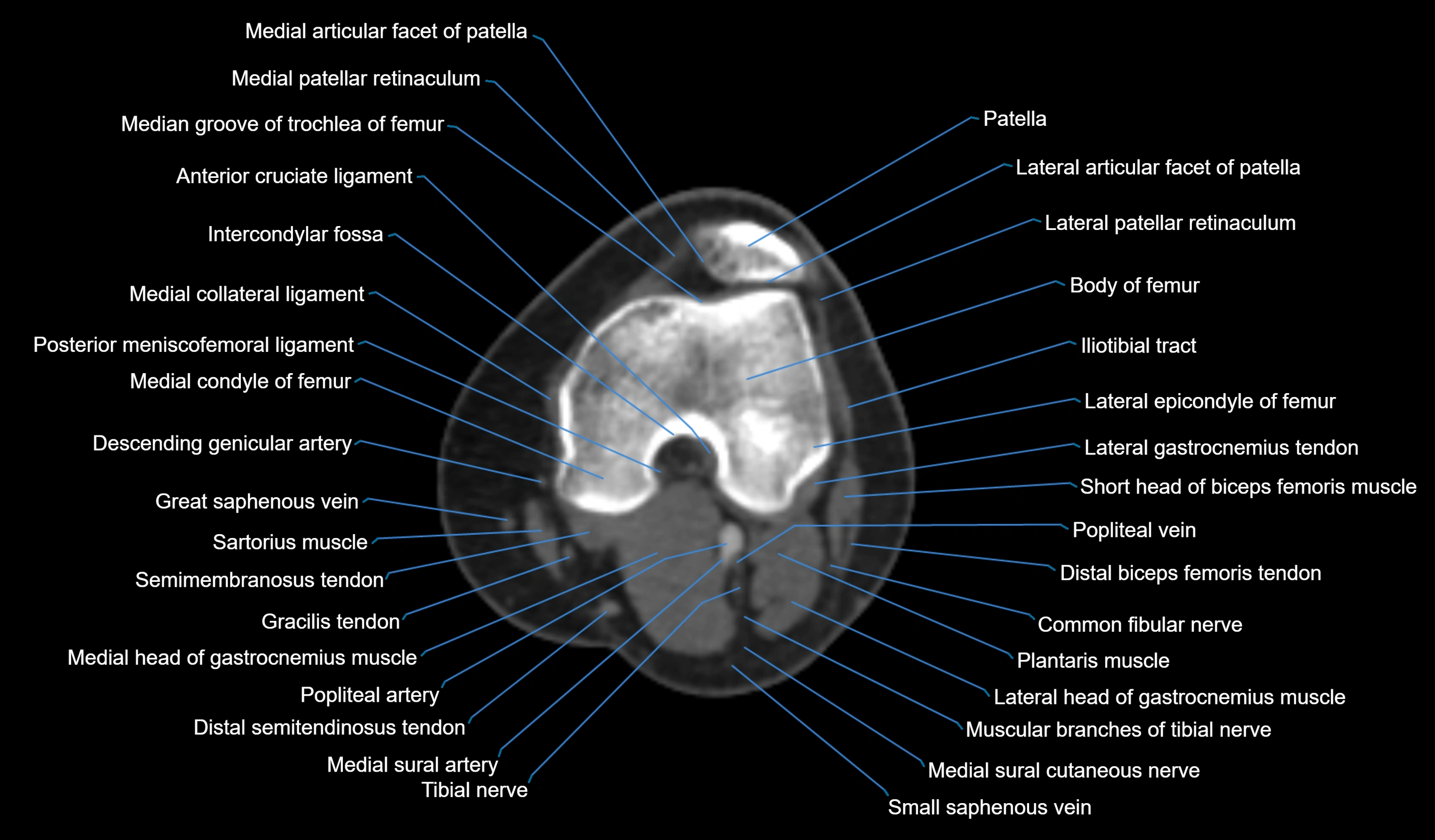 CT knee axial cross sectional anatomy labelled image-00028.webp